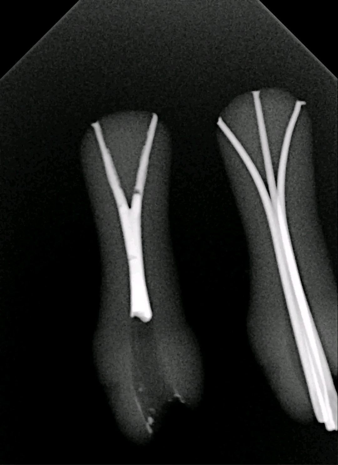 Apical Splits