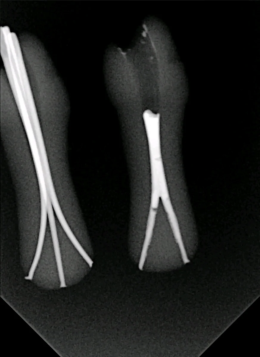 2-Branch Apical Split — image 1 of 2