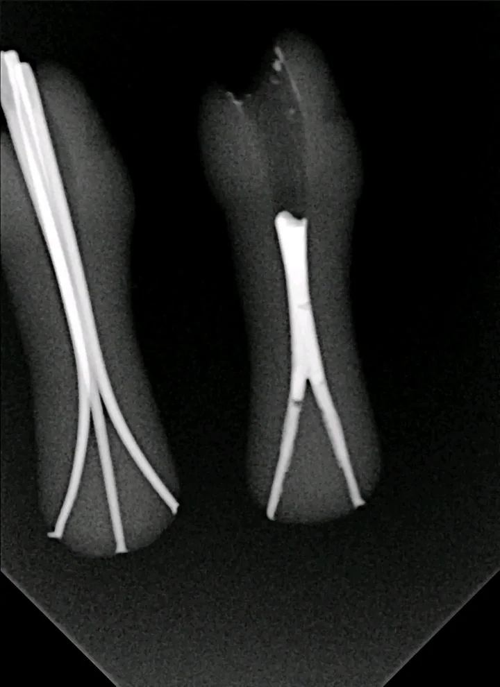 2-Branch Apical Split — 4K-APS-2B