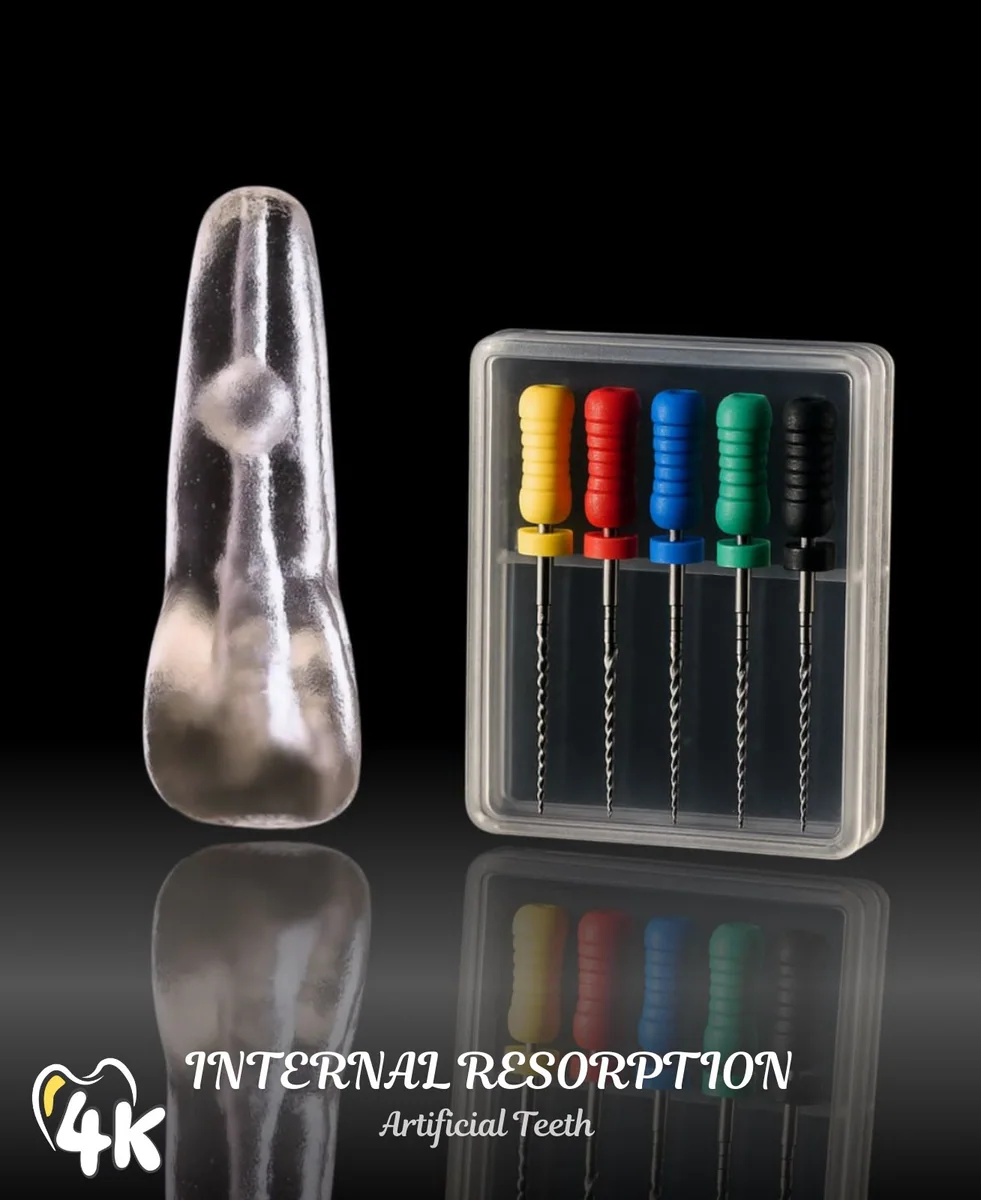 Internal Resorption — Incisor — image 1 of 3